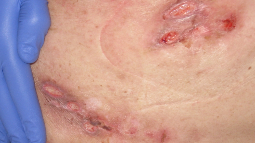 Hình ảnh giải thích ghẻ ruồi là gì với tổn thương loét, đóng vảy cứng đặc trưng.