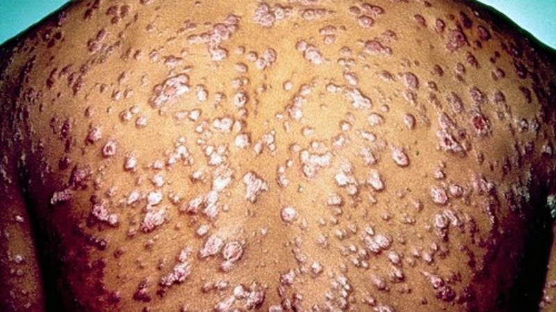 Hình ảnh bệnh giang mai ở miệng