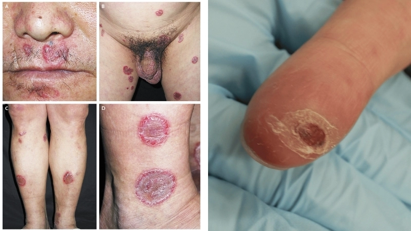 Biểu hiện bệnh giang mai ở nam Hình ảnh