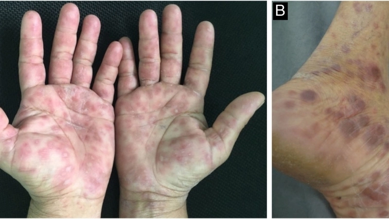 Hình ảnh bệnh giang mai ở vùng kín