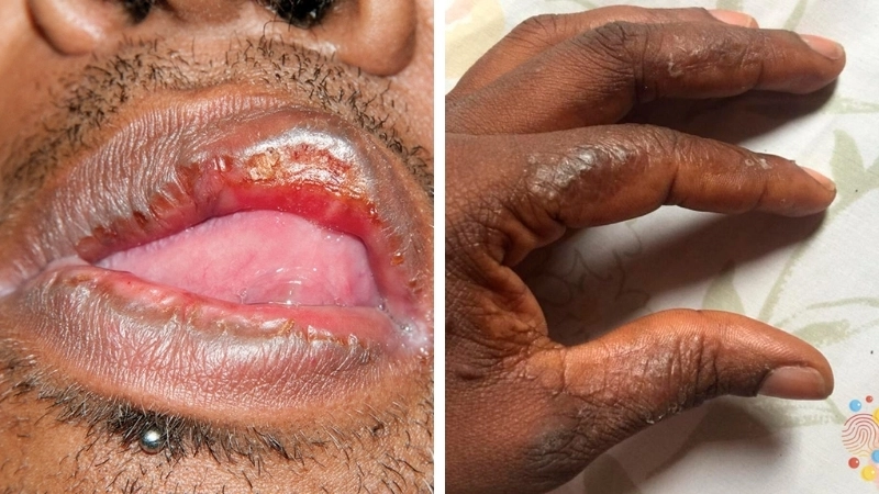 Hình ảnh bệnh lậu và giang mai