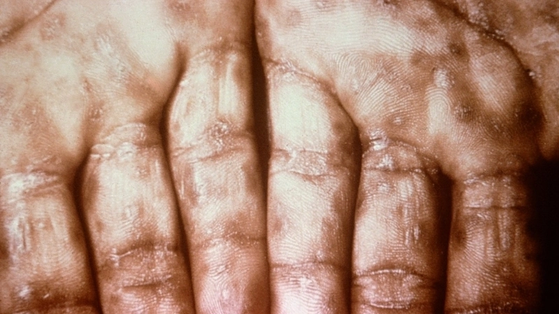 Hình ảnh bệnh giang mai ở trẻ em