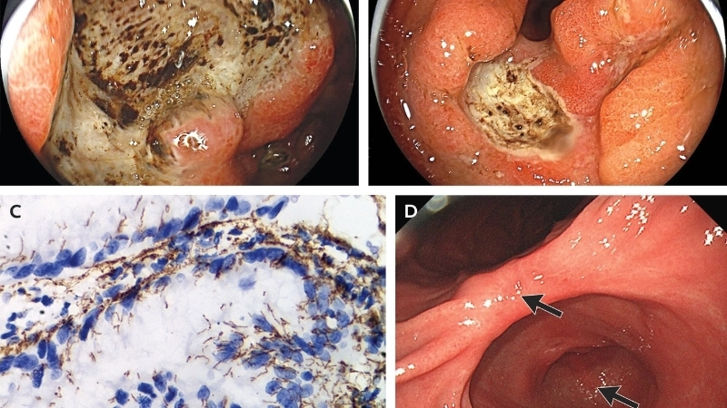 Hình ảnh bệnh giang mai giai đoạn đầu