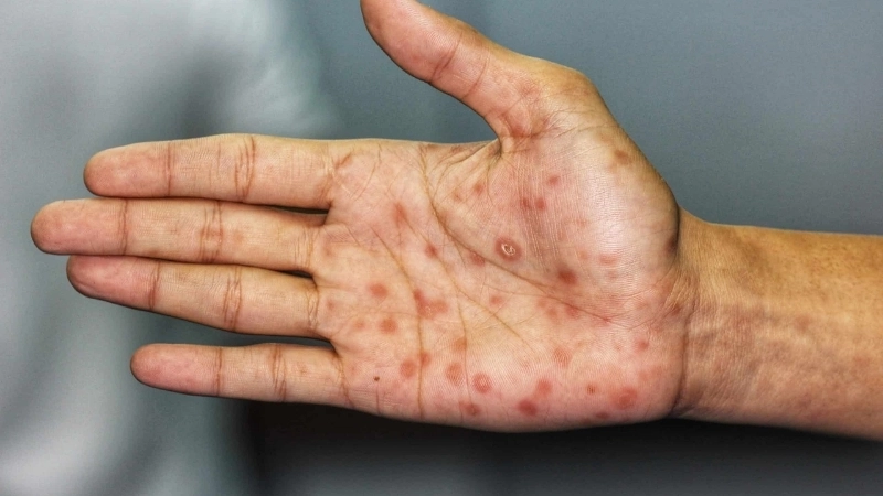 Hình ảnh dấu hiệu bệnh giang mai ở nam giới