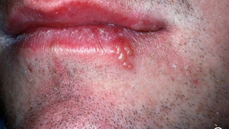 Giải đáp thắc mắc bị giời leo có lây không