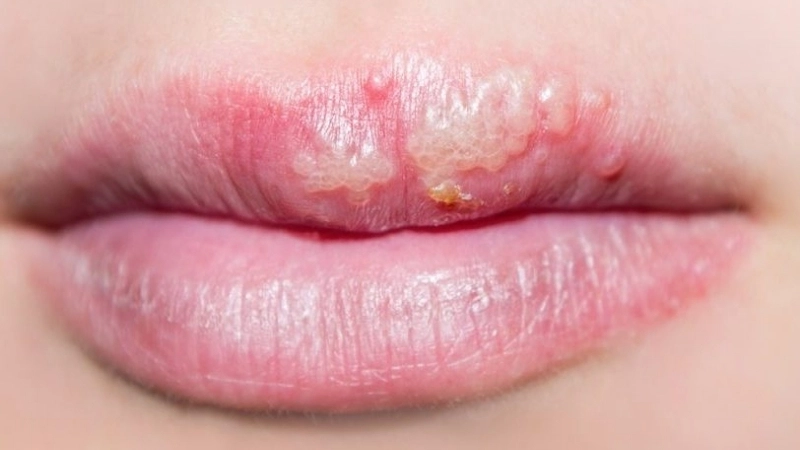 Các mẹo chữa giời leo dân gian cần cẩn trọng