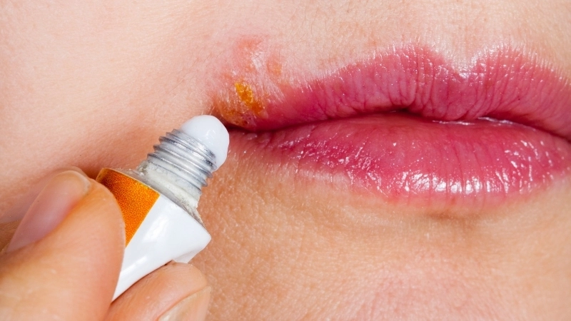 Biến chứng nguy hiểm của giời leo ở mắt