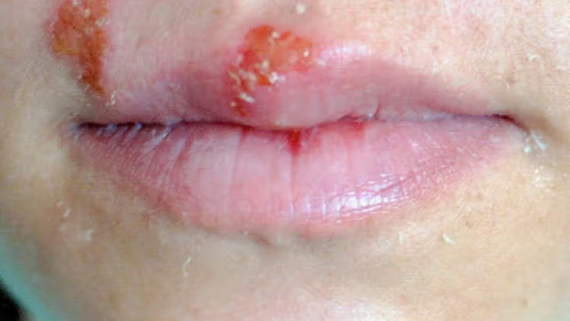 Tổng hợp các cách chữa giời leo ở môi