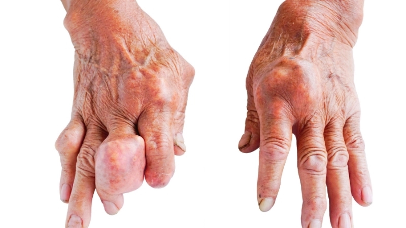 Hình ảnh người bị bệnh gút đang trong cơn đau cấp