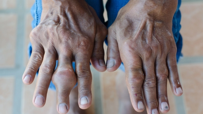 Ảnh bệnh gout ở giai đoạn mạn tính