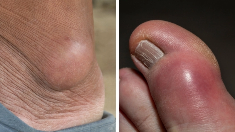 Hình ảnh bệnh nhân bị gout được chẩn đoán