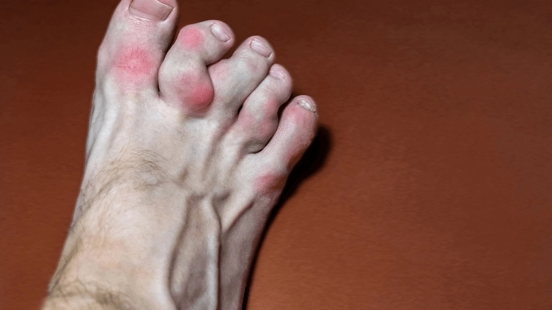 Hình ảnh bệnh nhân gút với hạt tophi ở khuỷu tay