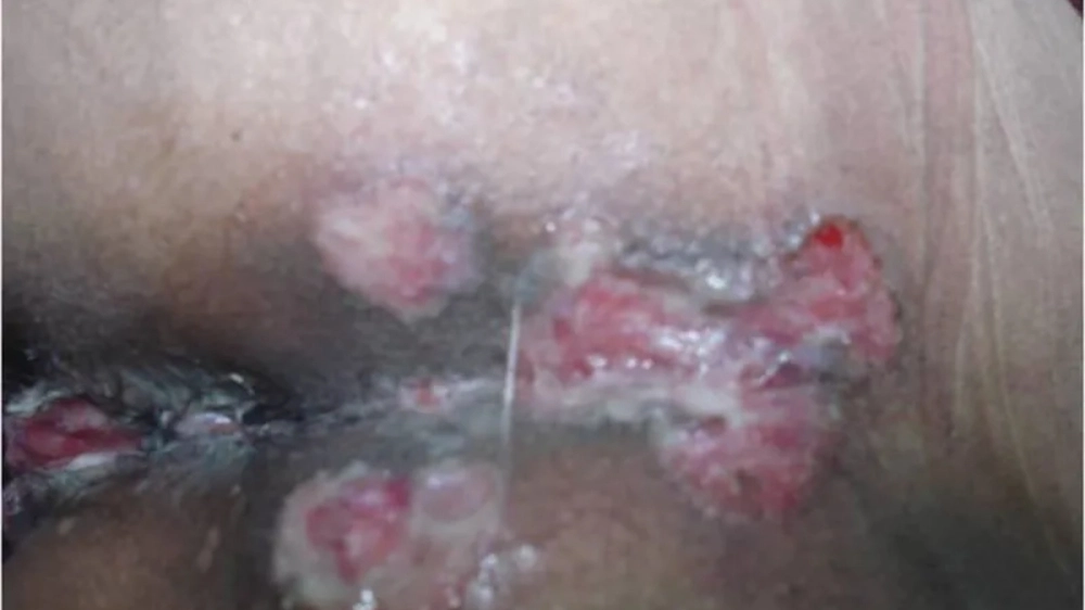 Minh họa cách chữa bệnh hạ cam bằng kháng sinh