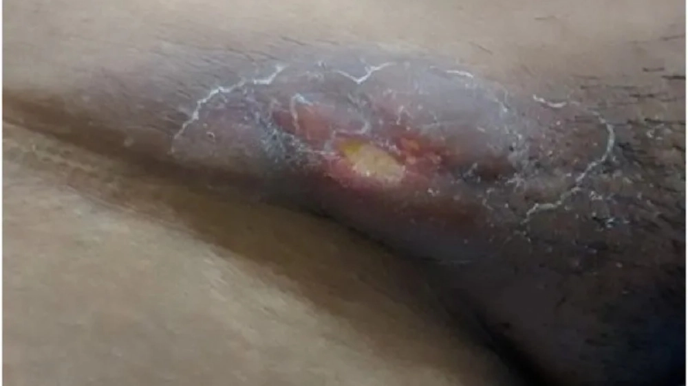 Bảng phân biệt hạ cam và giang mai qua hình ảnh vết loét