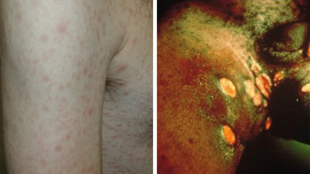 Các loại thuốc điều trị hạ cam được bác sĩ chỉ định