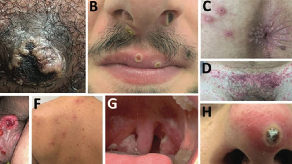 Tình trạng sưng hạch bẹn do biến chứng của bệnh hạ cam