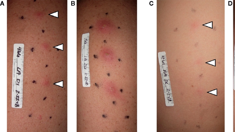 So sánh tổn thương hạ cam ở nam giới và nữ giới