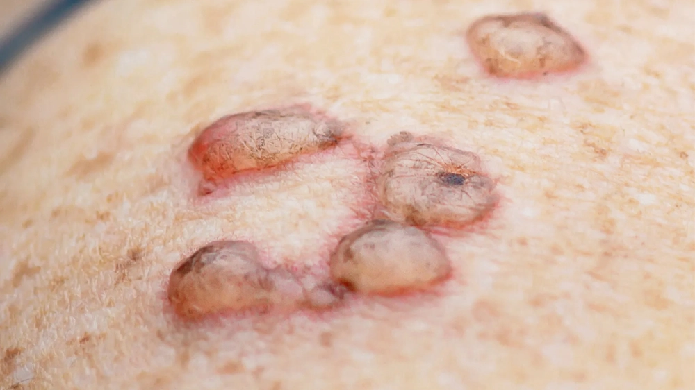 Hình ảnh vi khuẩn Haemophilus ducreyi dưới kính hiển vi, tác nhân chính gây bệnh hạ cam