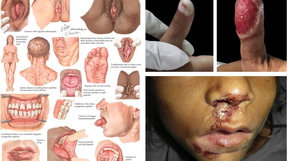 Biểu hiện lâm sàng của bệnh hạ cam ở nam giới