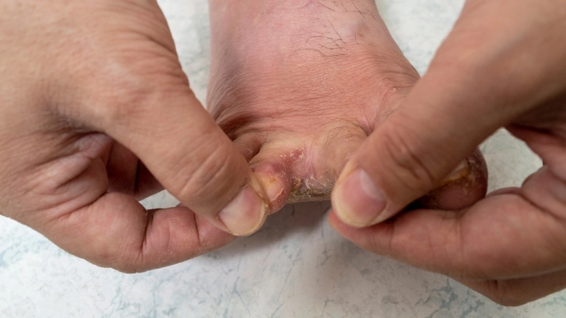 So sánh để phân biệt hắc lào và lang ben