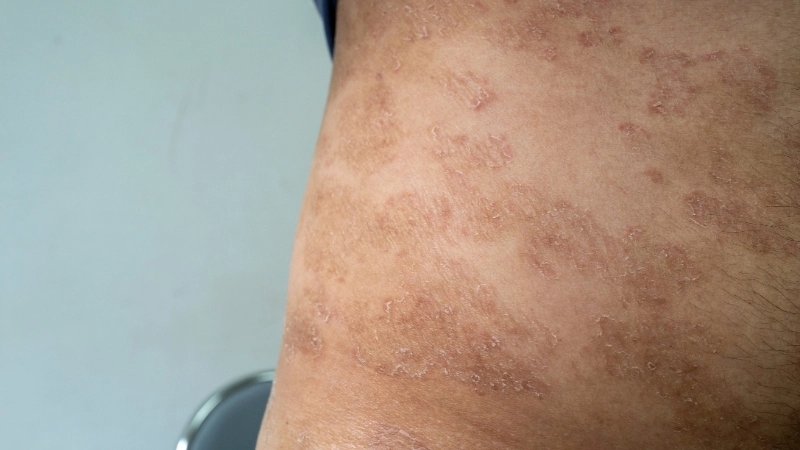 Lý giải nguyên nhân bị hắc lào thường gặp