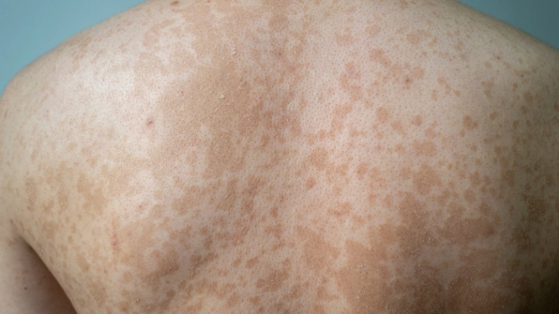 Hướng dẫn sử dụng thuốc trị hắc lào Nizoral