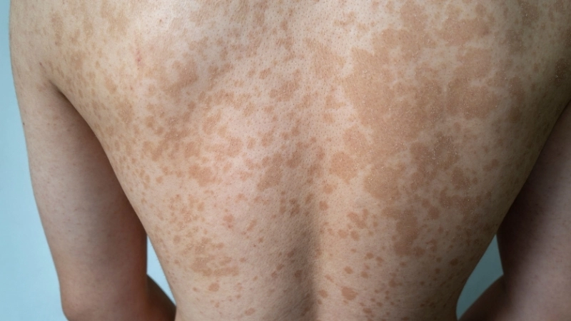 Hình ảnh hắc lào ở giai đoạn khởi phát