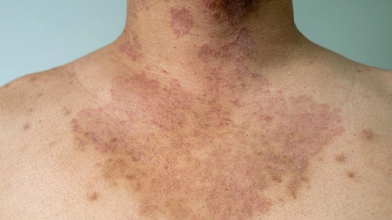 Các dấu hiệu bệnh hắc lào điển hình trên da