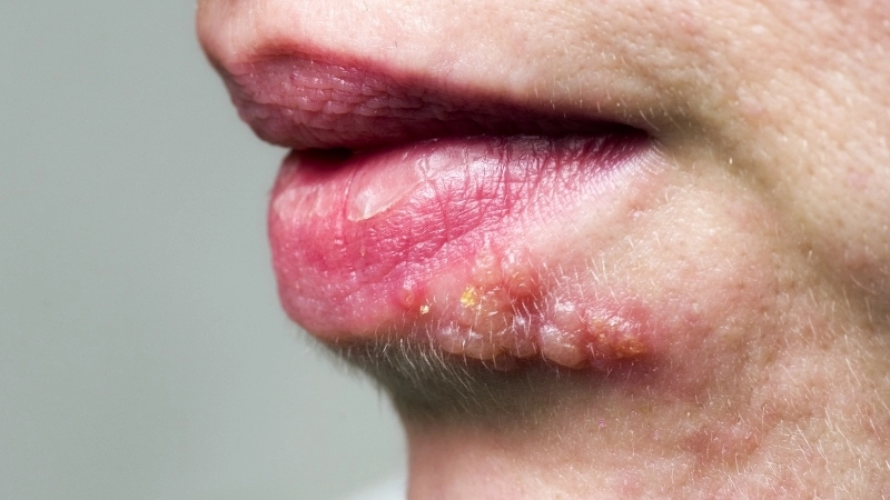 Minh họa cách chữa bệnh Herpes bằng thuốc kháng virus đường uống