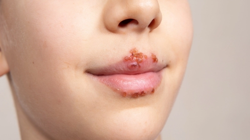 So sánh và phân biệt Herpes và Zona qua hình ảnh tổn thương