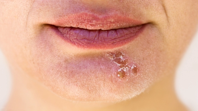 Giải đáp: Bệnh Herpes có chữa khỏi được không qua các liệu pháp hiện tại