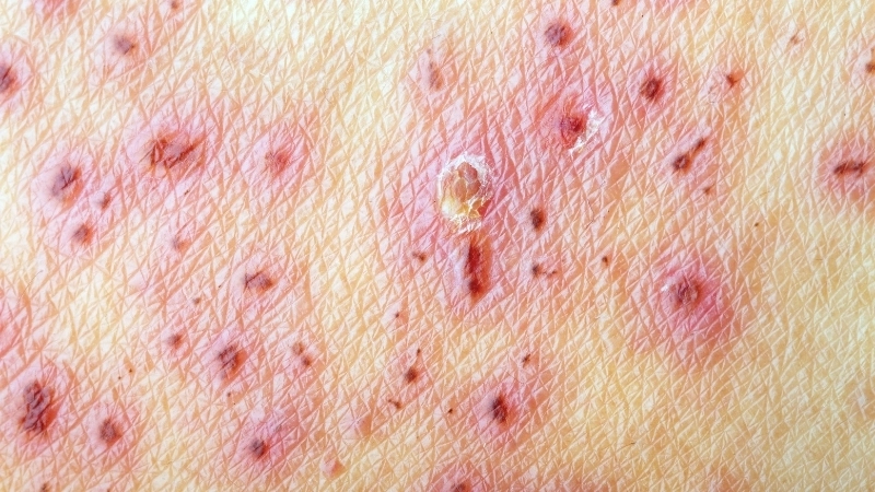 Các dấu hiệu nhận biết của Herpes sinh dục nam
