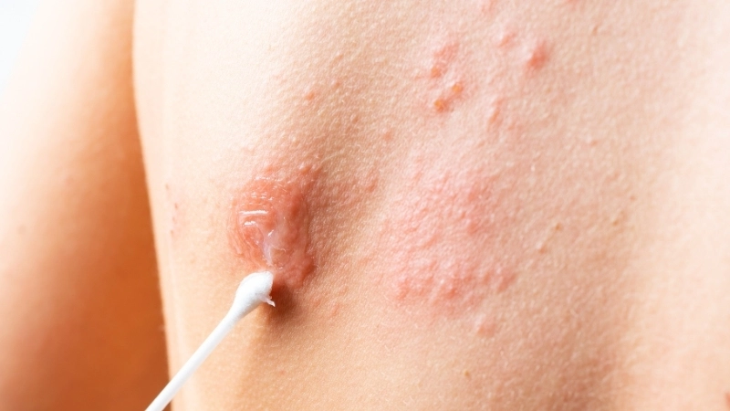 Giai đoạn đóng vảy của mụn rộp sau khi tìm cách chữa bệnh Herpes