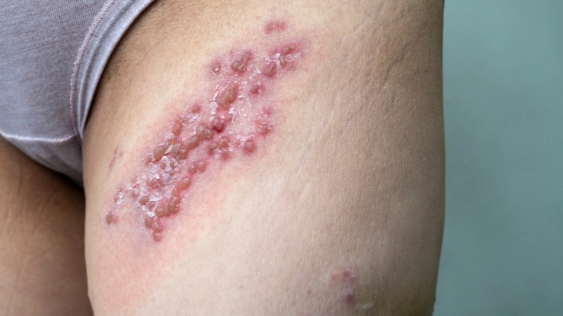 Virus HSV là tác nhân chính gây ra các tổn thương mụn nước trên da và niêm mạc.