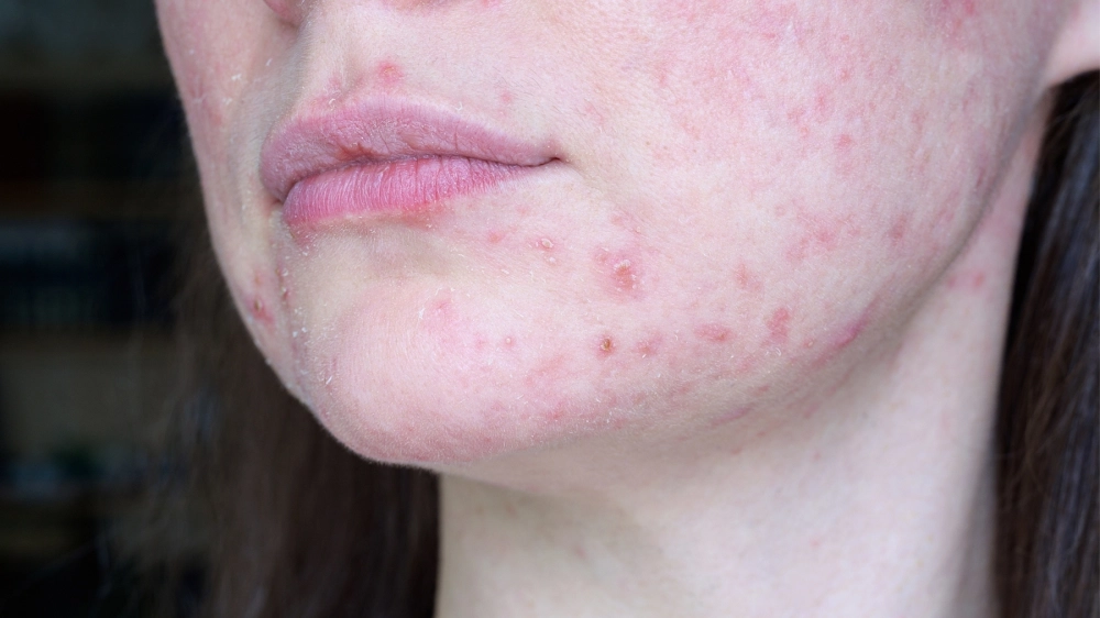 Các cách điều trị hồng ban đa dạng hiệu quả hiện nay