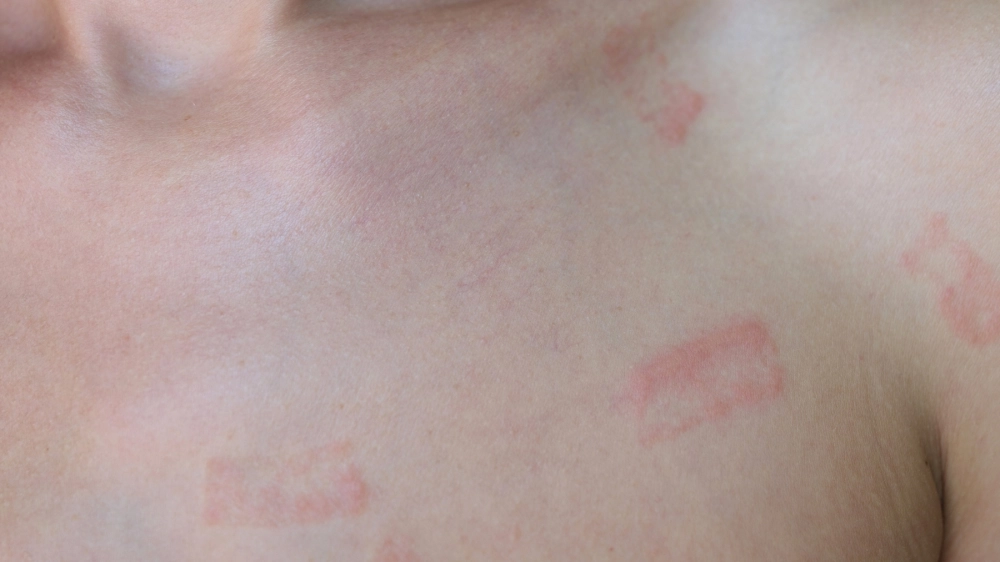 Biểu hiện hồng ban đa dạng ở niêm mạc miệng