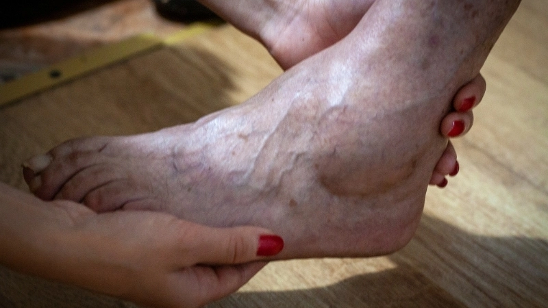 Hình ảnh người bị bệnh hủi và những di chứng