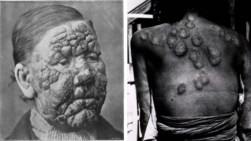 Phân biệt các triệu chứng bệnh hủi ban đầu