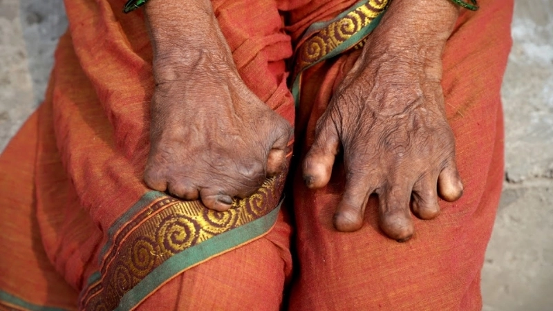 Hình ảnh người bị bệnh hủi đã được điều trị thành công