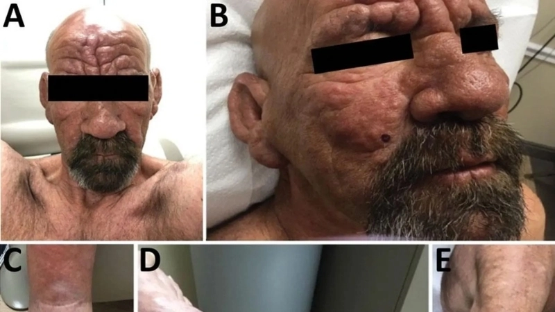 Hình ảnh tổn thương da do vi khuẩn Hansen gây ra