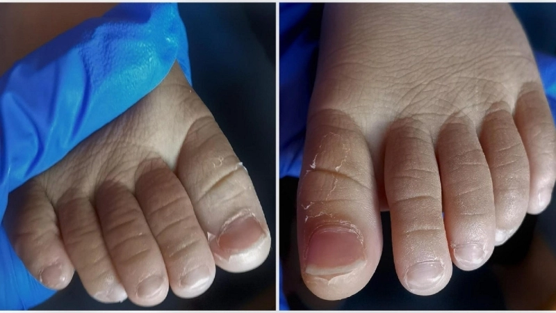 Giải đáp thắc mắc: Bệnh Kawasaki có nguy hiểm không?