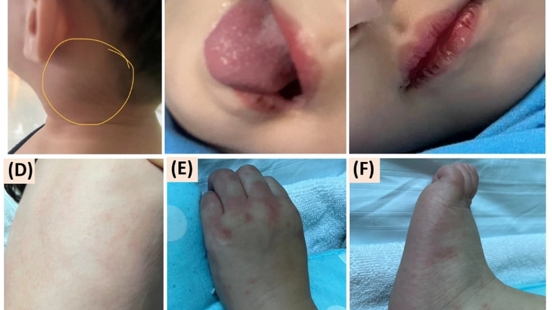 Minh họa di chứng bệnh Kawasaki nếu chậm trễ điều trị