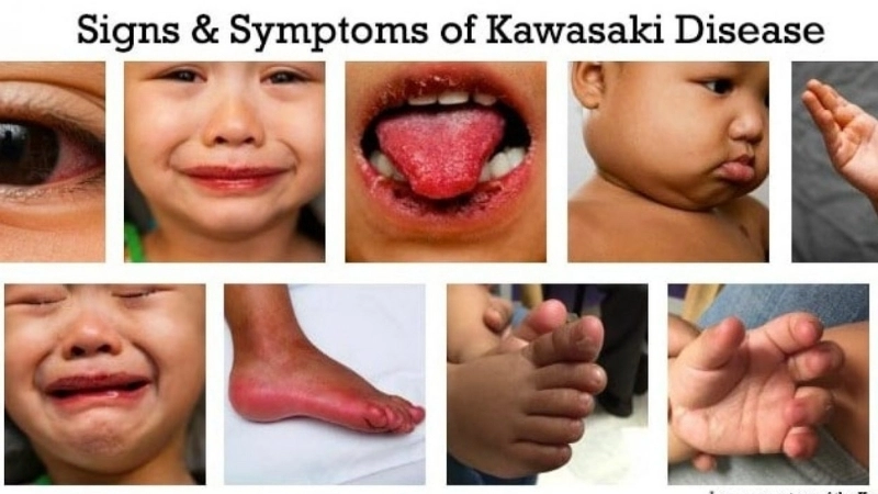 Hình ảnh lưỡi dâu tây Kawasaki đặc trưng