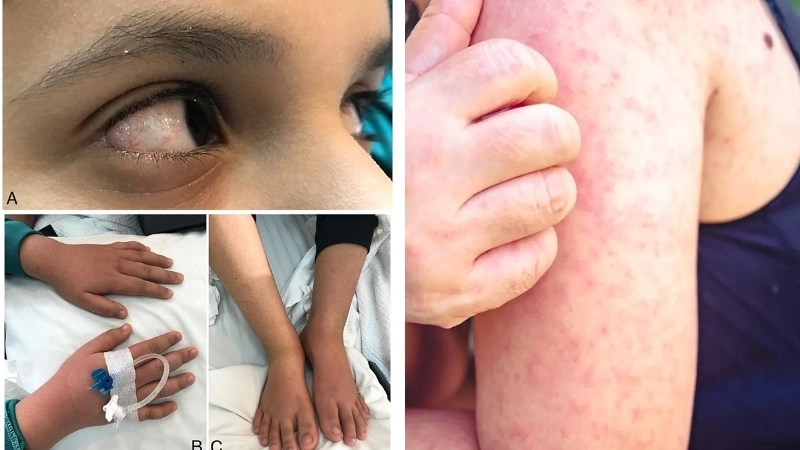 Khẳng định y khoa: Bệnh Kawasaki có lây không?