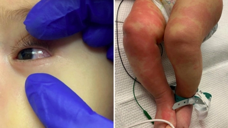 Sưng hạch bạch huyết ở cổ, một dấu hiệu bệnh Kawasaki