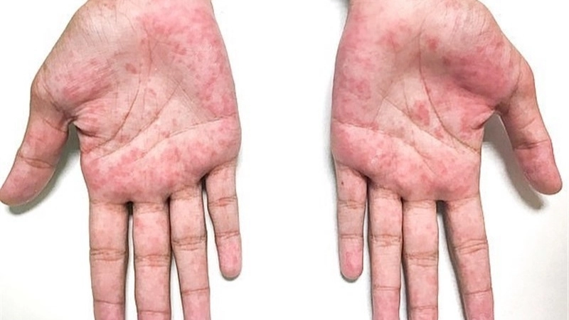 Hiện tượng bong tróc da đầu ngón tay và chân