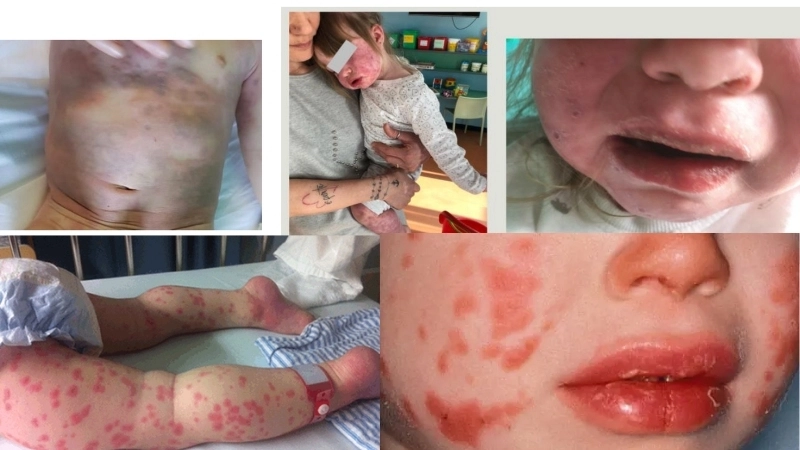 Tổng hợp các triệu chứng bệnh Kawasaki ở trẻ em