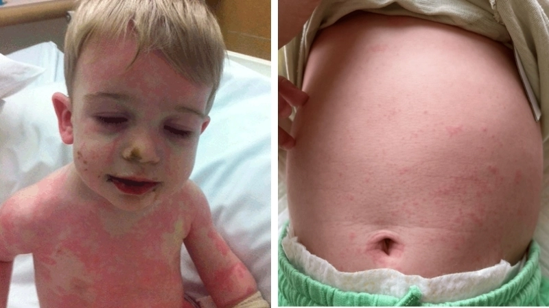 Hình ảnh siêu âm biến chứng bệnh Kawasaki trên tim