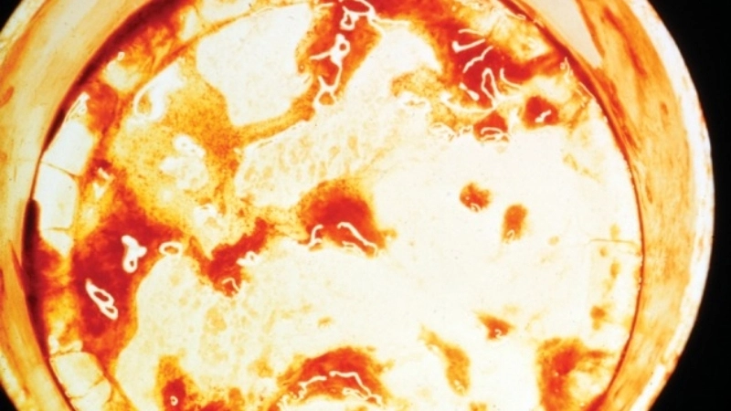 Biến chứng mất nước nguy hiểm của bệnh kiết lỵ ở người lớn