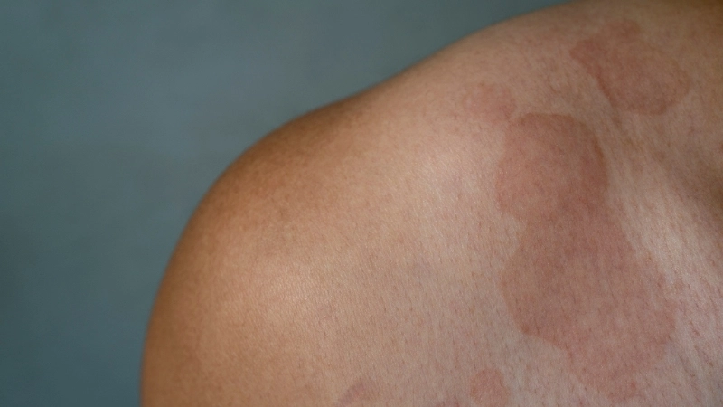 Giải đáp thắc mắc lang ben có lây không trong sinh hoạt